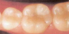 金属と虫歯の部分を除去し歯と同色の材料を詰めました。この治療は1回で終了し、健康保険も適応されます。