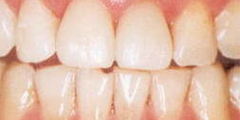 歯を一層削りラミネートベニア修復をしました。歯を削る量は最小限で、前歯の形態及び色調を改善しました。