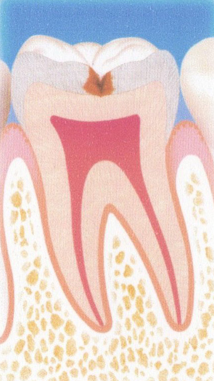 虫歯の進行と治療