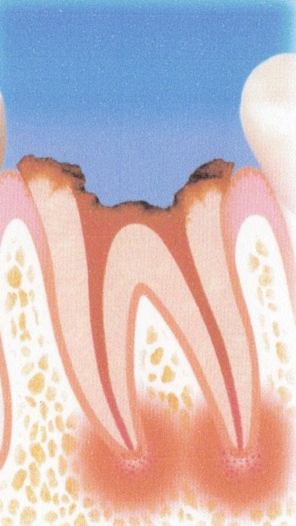 C4（歯根まで達した虫歯）